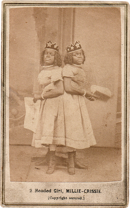 Millie-Christine McCoy the Two-headed Nightingale